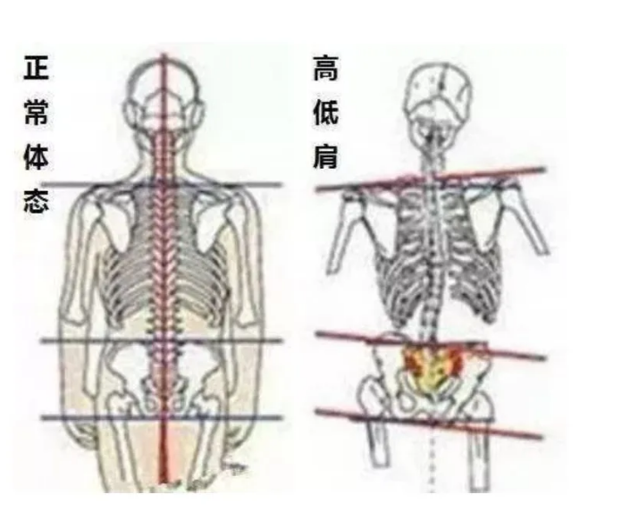 罕见!福建4岁男孩左肩高出右肩5公分