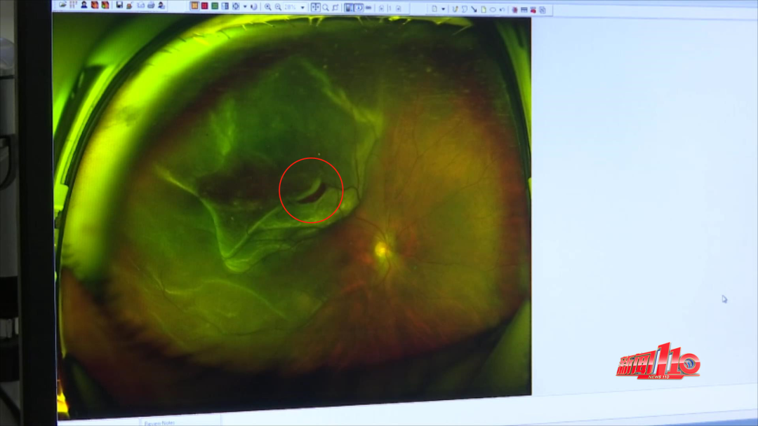 >热报 通过眼底照相发现,小陈的右眼颞上方已经发生孔源性视网膜脱离