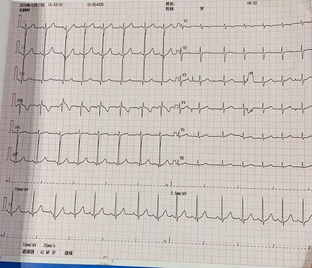 前不久 厦门5岁男孩周周(化名) 的心跳竟然 每分钟多达200多次 上