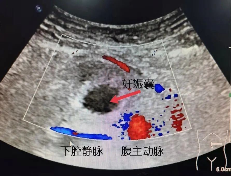 但是医生做了2次彩超 却没在子宫内外发现宝宝 淘气的宝宝藏哪儿啦?