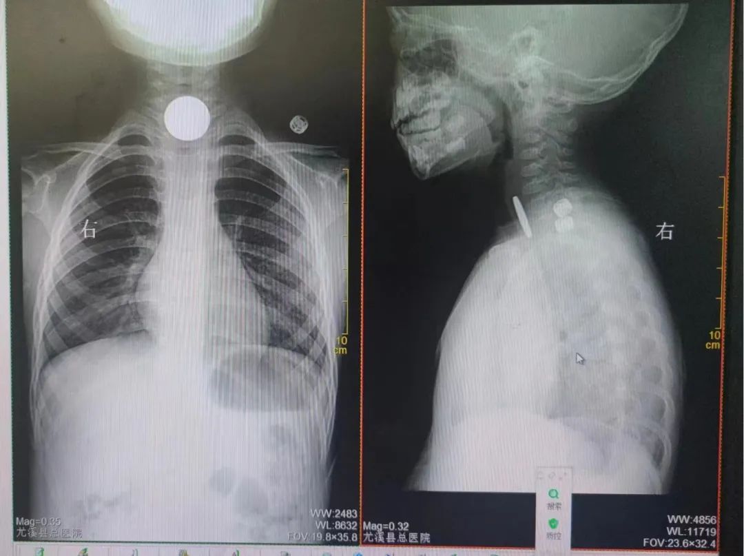 争分夺秒！尤溪4岁男童误吞硬币，150公里接力救援